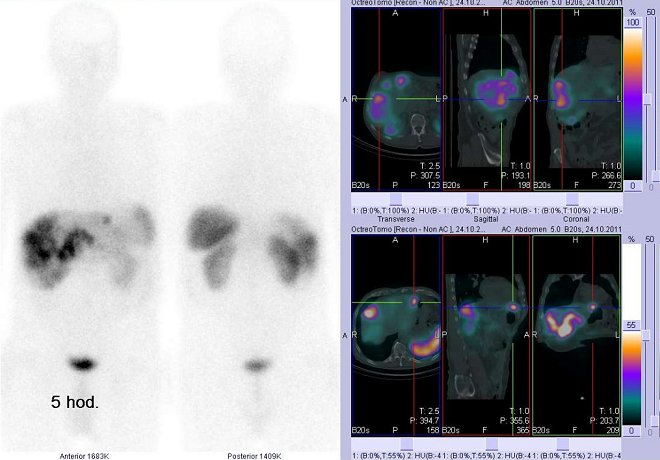Obr. . 4: Celotlov scintigrafie v pedn a zadn projekci a fze obraz SPECT a CT. Vyeten 5 hod. po aplikaci radioindiktoru. Vpravo nahoe: zameno na loisko v pravm jaternm laloku. Vpravo dole: zameno na loisko v levm jaternm laloku.