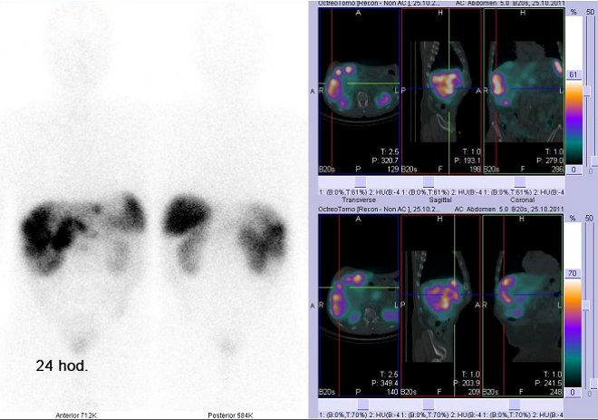 Obr. . 7: Celotlov scintigrafie v pedn a zadn projekci a fze obraz SPECT a CT. Vyeten 24 hod. po aplikaci radioindiktoru. Vpravo: zameno na loisko v pravm jaternm laloku.