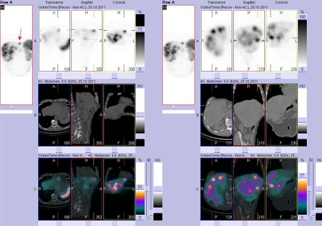 Obr. . 8: Fze obraz SPECT a CT. Vyeten 24 hod. po aplikaci radioindiktoru. Vlevo zameno na loisko v levm jaternm laloku, vpravo patrn a splvajc loiska v pravm jaternm laloku.