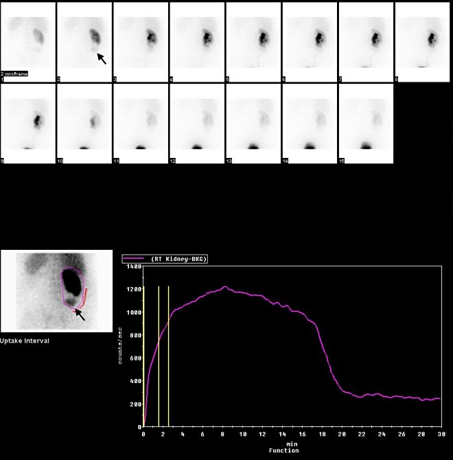 Obr. . 3: Dynamick scintigrafie ledvin. V horn srii obrzk dynamick zznam  2 min., vlevo dole sumace dat a vpravo dole nefrografick kivka z ROI z oblasti prav ledviny. Ve zmnn loisko oznaeno ipkou.