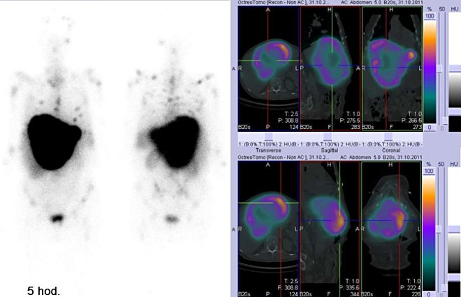 Obr. . 2: Celotlov scintigrafie v pedn a zadn projekci a fze obraz SPECT a CT. Vyeten 5 hod. po aplikaci radioindiktoru. Vpravo: zameno na obrovsk loisko v jtrech.