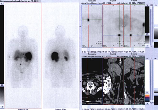 Obr. . 3: Celotlov scintigrafie v pedn a zadn projekci a fze obraz SPECT a CT. Vyeten 24 hod. po aplikaci radioindiktoru. Zameno na loisko v pravm mesogastriu.