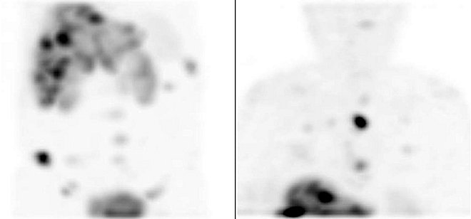 Obr. . 3: Tomografick scintigrafie SPECT. Vyeten 4 hod. po aplikaci radioindiktoru. Vlevo SPECT bicha a pnve, vpravo SPECT hrudnku.
