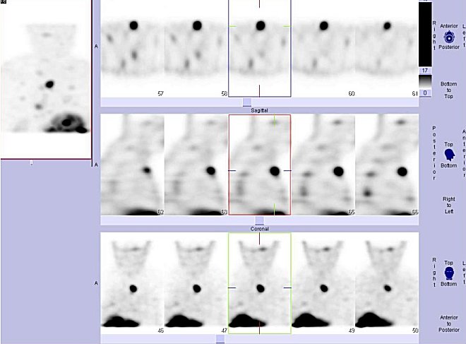 Obr. . 4: Tomografick scintigrafie SPECT hrudnku. Vyeten 4 hod. po aplikaci radioindiktoru.