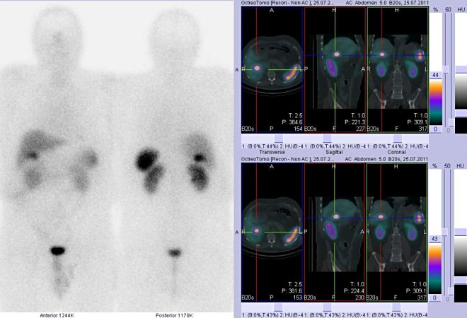Obr. č. 1: Celotělová scintigrafie v přední a zadní projekci a fúze obrazů SPECT a CT. Vyšetření 4 hod. po aplikaci radioindikátoru. Vpravo: zaměřeno na ložisko v játrech.