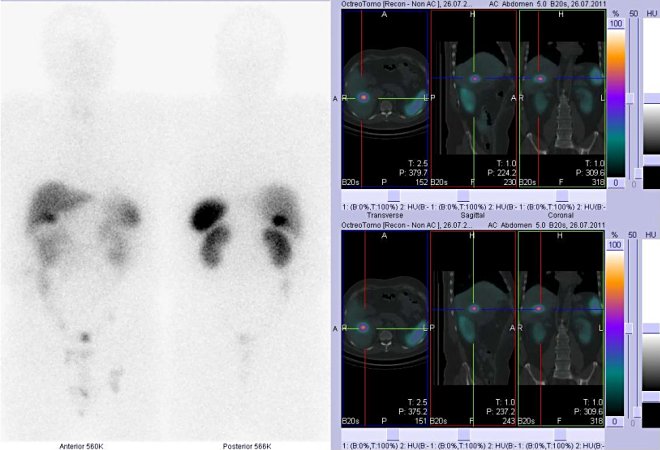 Obr. č. 2: Celotělová scintigrafie v přední a zadní projekci a fúze obrazů SPECT a CT. Vyšetření 24 hod. po aplikaci radioindikátoru. Vpravo: zaměřeno na ložisko v játrech.