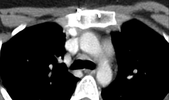 Obr. 9: CT hrudnku s iv. kontrastem (st PET/CT z 27.6.2013) ped karinou patrn denzn tk, kde by se mohlo jednat o cca. 10mm LU.