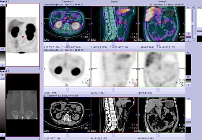 Obr..3: Fze obraz SPECT a CT. Vyeten 4 hod. po aplikaci radioindiktoru. Zameno na loisko na rozhran epigastria a mesogastria tsn vpravo od stedn ry.