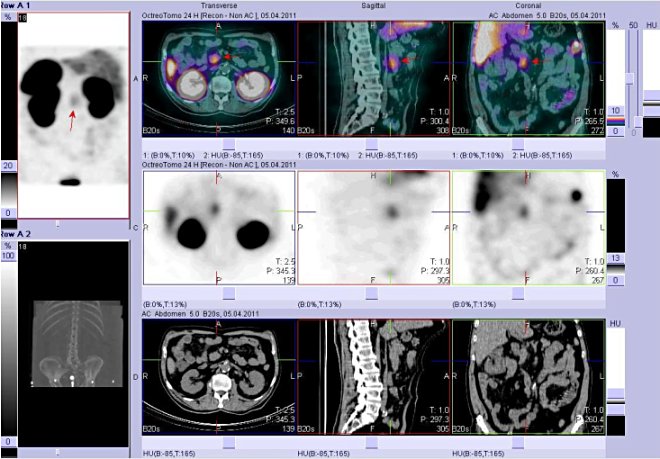 Obr. . 4: Fze obraz SPECT a CT. Vyeten 24 hod. po aplikaci radioindiktoru. Zameno na loisko na rozhran epigastria a mesogastria tsn vpravo od stedn ry.