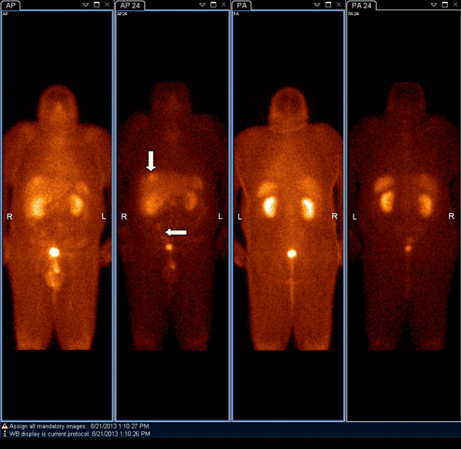 Obr.1: Scintigrafie pomoc 111In-OctreoScan metodou whole body za 4 a  24 hodin po aplikaci radiofarmaka s  vceetnmi patologickmi loiskovmi depozicemi radiofarmaka v oblasti jater a v pravm hypogastriu.