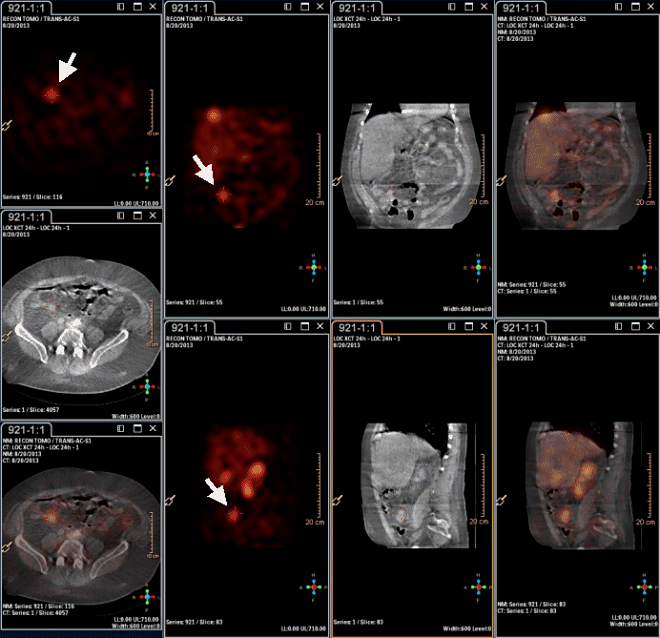 Obr.3: Scintigrafie pomoc 111In-OctreoScan metodou SPECT/CT s nslednou rekonstrukc v rovin transversln, sagitln a koronln za 24 hodin po aplikaci radiofarmaka s patologickou depozic radiofarmaka v pravm hypogastriu.