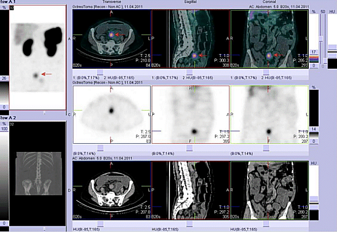 Obr. . 3: Fze obraz SPECT a CT. Vyeten 4 hod. po aplikaci radioindiktoru. Zameno na loisko v pnvi ve stedn e.
