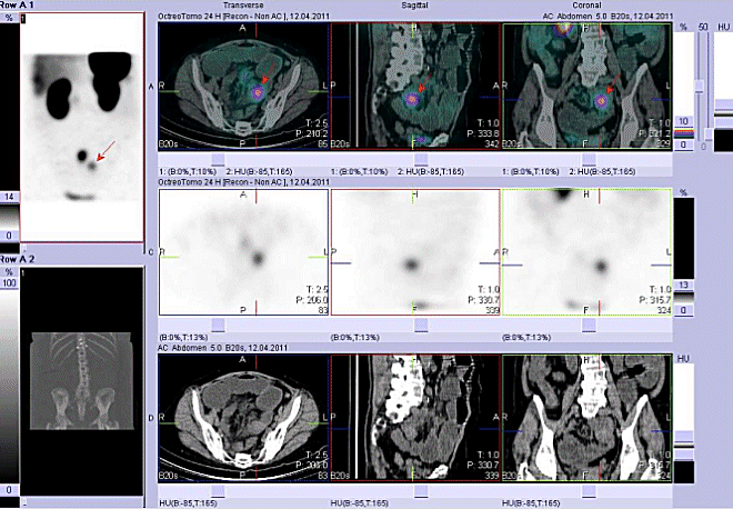 Obr. . 5: Fze obraz SPECT a CT. Vyeten 24 hod. po aplikaci radioindiktoru. Zameno na loisko v pnvi vlevo od stedn ry.
