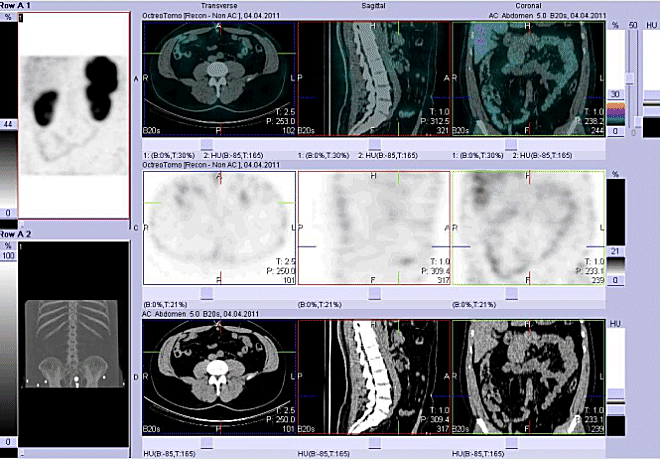 Obr. 3: Fze obraz SPECT a CT. Vyeten 4 hod. po aplikaci radioindiktoru.
