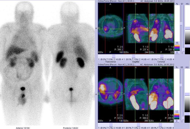 Obr. . 1: Celotlov scintigrafie v pedn a zadn projekci a fze obraz SPECT/CT. Vyeten 4 hod. po aplikaci radioindiktoru. Vpravo nahoe zameno na velk loisko v horn sti prav plce. Vpravo dole akumulace v srdci.