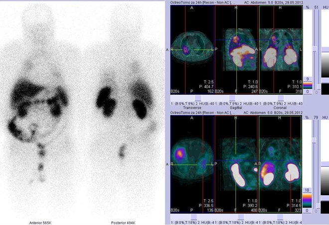 Obr. . 5: Celotlov scintigrafie v pedn a zadn projekci a fze obraz SPECT/CT. Vyeten 24 hod. po aplikaci radioindiktoru. Vpravo nahoe zameno na velk loisko v horn sti prav plce. Vpravo dole akumulace v srdci.