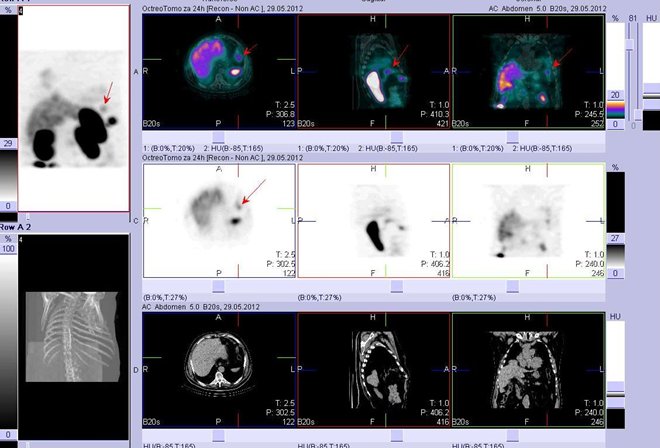 Obr. . 7: Fze obraz SPECT a CT. Vyeten 24 hod. po aplikaci radioindiktoru. Vpravo nahoe fze SPECT/CT, uprosted SPECT, dole CT. Zameno na loisko ve stev  fyziologick akumulace radiofarmaka.