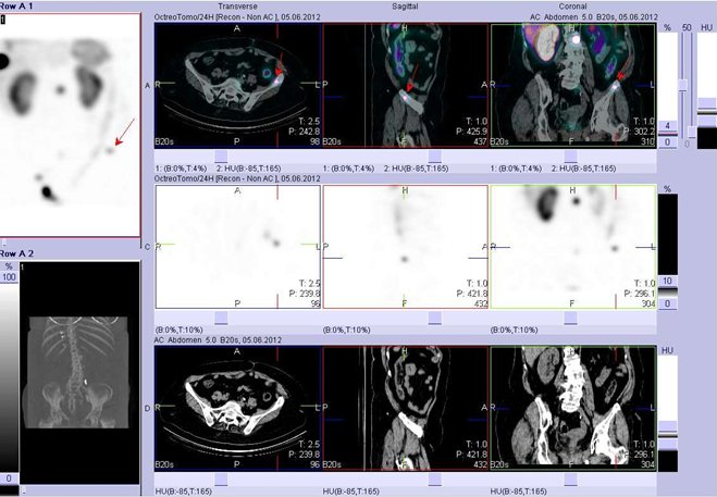 Obr. . 11: Fze obraz SPECT a CT. Vyeten 24 hod. po aplikaci radioindiktoru. Zameno na loisko v lopat lev kosti kyeln.