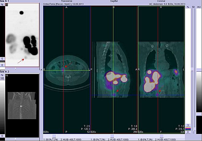 Obr..2: Fze obraz SPECT a CT  hrudnk a proximln st bicha. Vyeten 4 hod. po aplikaci radioindiktoru. Vlevo transverzln ez, uprosted sagitln ez, vpravo koronln. Zameno na loisko v prav sti bicha.
