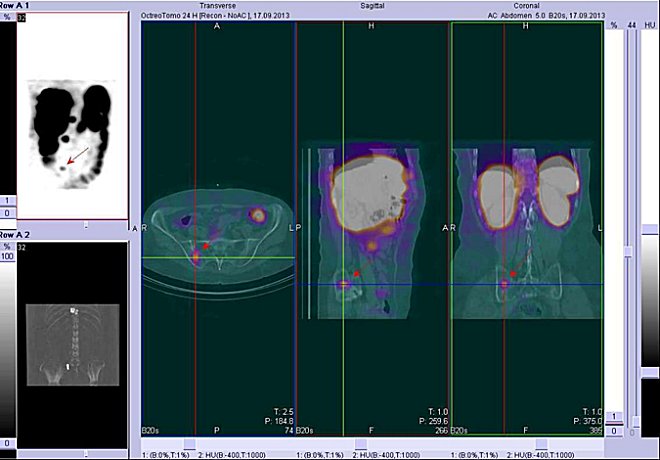 Obr. . 5: Fze obraz SPECT a CT  bicho. Vyeten 24 hod. po aplikaci radioindiktoru. Vlevo transverzln ez, uprosted sagitln ez, vpravo koronln. Zameno na loisko v lopat prav kosti kyeln.