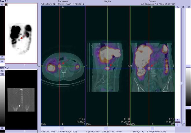 Obr. . 6: Fze obraz SPECT a CT  bicho. Vyeten 24 hod. po aplikaci radioindiktoru. Vlevo transverzln ez, uprosted sagitln ez, vpravo koronln. Zameno na loisko v prav sti bicha.