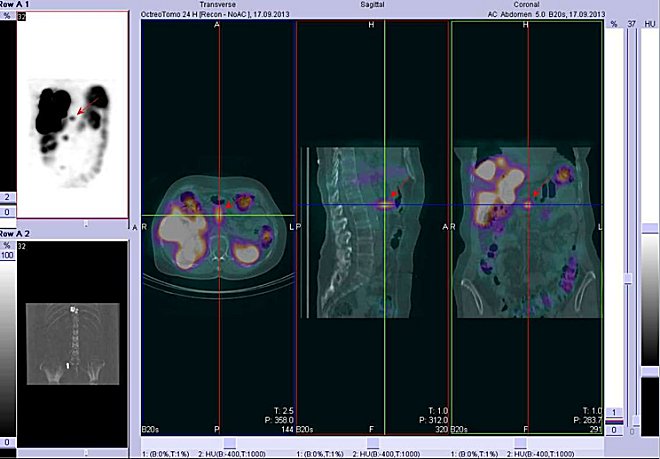 Obr. . 7: Fze obraz SPECT a CT  bicho. Vyeten 24 hod. po aplikaci radioindiktoru. Vlevo transverzln ez, uprosted sagitln ez, vpravo koronln. Zameno na loisko v bie ve stedn e.