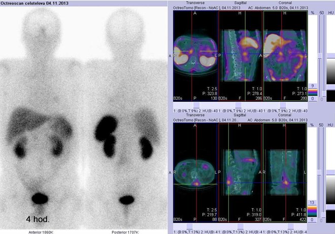Obr. . 2: Celotlov scintigrafie v pedn a zadn projekci (vlevo) a fze obraz SPECT a CT (vpravo)  vyeten bicha. Vpravo nahoe zameno na aktivitu ve stevech, vpravo dole zameno na aktivitu na zdech. Vpravo vdy nad sebou: vlevo transverzln ezy, uprosted sagitln ezy, vpravo koronrn. Vyeten 4 hod. po aplikaci radioindiktoru.