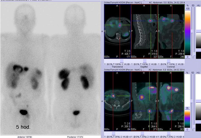 Obr..1: Celotlov scintigrafie v pedn a zadn projekci a fze obraz SPECT a CT. Vyeten 5 hod. po aplikaci radioindiktoru. Vpravo nahoe zameno na  loisko v levm jaternm laloku, vpravo dole zameno na loisko v pravm mesogastriu.