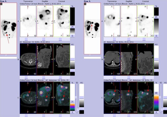 Obr. . 3: Fze obraz SPECT a CT  vyeten bicha. Vyeten 24 hod. po aplikaci radiofarmaka. Vlevo nahoe SPECT, vlevo uprosted CT, vlevo dole fze obraz, zameno na loisko v pravm mesogastriu. Vpravo nahoe SPECT, vpravo uprosted CT, vpravo dole fze obraz, zameno na loisko v levm jaternm laloku.