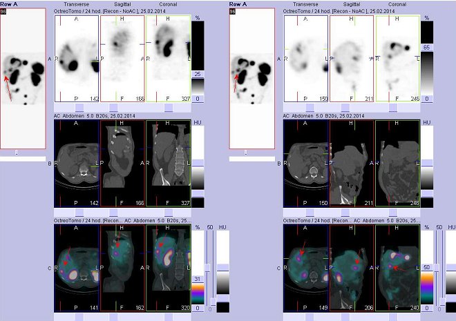 Obr..4: Fze obraz SPECT a CT  vyeten bicha. Vyeten 24 hod. po aplikaci radiofarmaka. Vlevo nahoe SPECT, vlevo uprosted CT, vlevo dole fze obraz, zameno na loisko v pravm jaternm laloku. Vpravo nahoe SPECT, vpravo uprosted CT, vpravo dole fze obraz, zameno na loisko v pravm jaternm laloku.