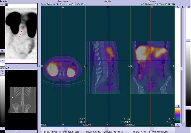 Obr. . 3: Fze obraz SPECT a CT. Vyeten 24 hod. po aplikaci radioindiktoru. Zameno na loisko v epigastriu vpravo od stedn ry.