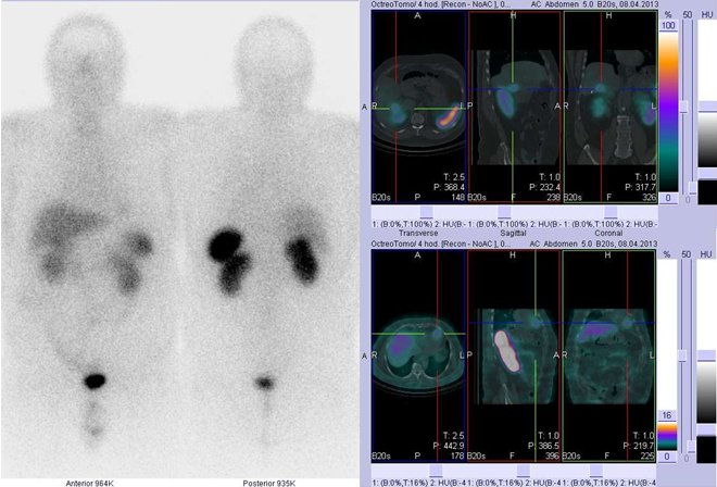 Obr. . 1: Celotlov scintigrafie v pedn a zadn projekci a fze obraz SPECT a CT. Vyeten 4 hod. po aplikaci radioindiktoru. Vpravo nahoe: zameno na loisko v jtrech, vpravo dole: zameno na nevrazn loisko v srdci.