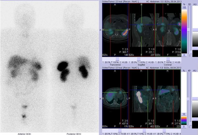 Obr. . 2: Celotlov scintigrafie v pedn a zadn projekci a fze obraz SPECT a CT. Vyeten 23 hod. po aplikaci radioindiktoru. Vpravo nahoe: zameno na loisko v jtrech, vpravo dole: zameno na nevrazn loisko v srdci.