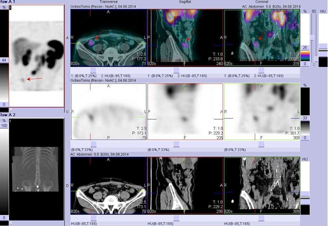 Obr. . 2: Fze obraz SPECT a CT  vyeten bicha. Vyeten 4 hod. po aplikaci radiofarmaka. Nahoe fze obraz, uprosted SPECT, dole CT. Vdy nad sebou: vlevo transverzln ezy, uprosted sagitln ezy, vpravo koronrn. Zameno na loisko v pravm hypogastriu.