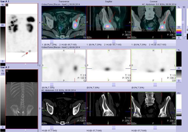 Obr. . 4: Fze obraz SPECT a CT. Vyeten 4,5 hod. po aplikaci radioindiktoru. Zameno na loisko v pnvi vlevo.