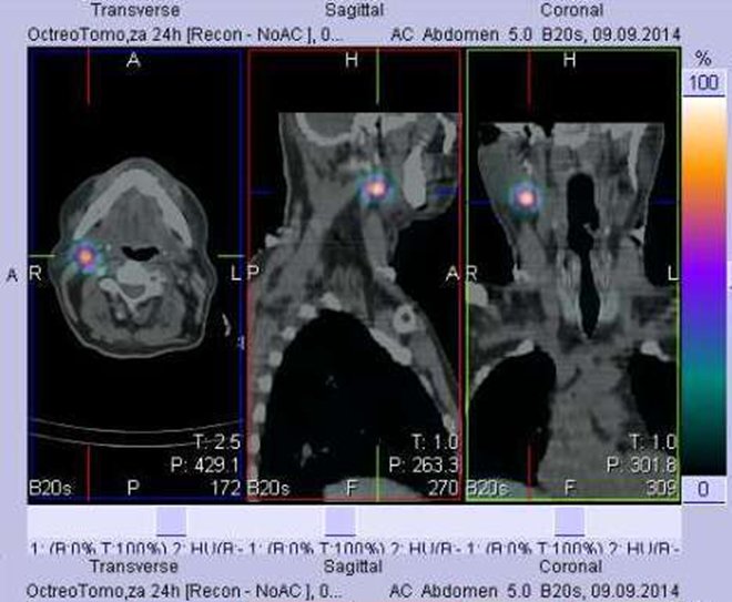 Obr. . 9: Fze obraz SPECT a CT. Vyeten 24 hod. po aplikaci radioindiktoru. Zameno na loisko v krn uzlin vpravo.