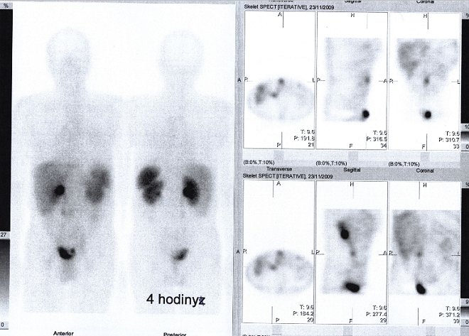 Obr.1: Celotlov scintigrafie v pedn a zadn projekci a tomografick scintigrafie bicha a pnve 4 hod. po aplikaci OctreoScanu.