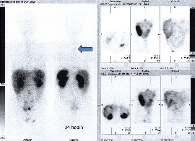 Obr.3: Celotlov scintigrafie v pedn a zadn projekci a tomografick scintigrafie bicha a pnve 24 hod. po aplikaci OctreoScanu.