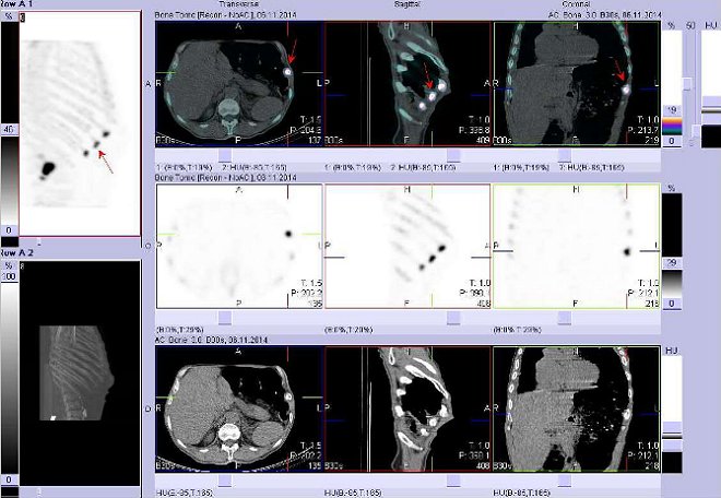Obr. . 8: Fze obraz SPECT a CT. Zameno na loisko v laterln sti 10. ebra vlevo.