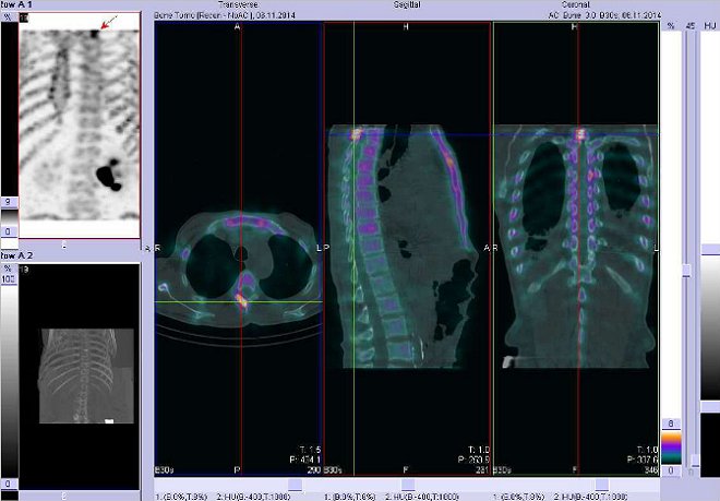 Obr. . 9: Fze obraz SPECT a CT.