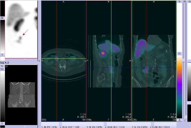 Obr. . 5: Fze obraz SPECT a CT. Zameno na loisko vpravm mesogastriu. ez transverzln, sagitln a koronrn. Vyeten 24 hod. po aplikaci OctreoScanu.