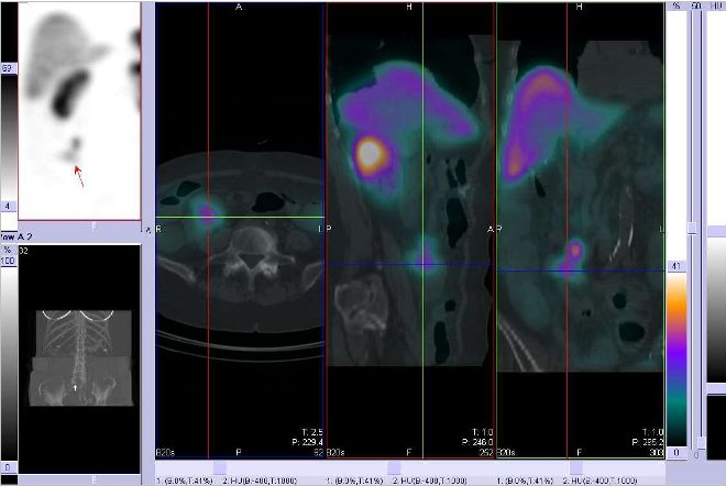 Obr. . 6: Fze obraz SPECT a CT. Zameno na loisko vpravm mesogastriu. ez transverzln, sagitln a koronrn. Vyeten 24 hod. po aplikaci OctreoScanu.