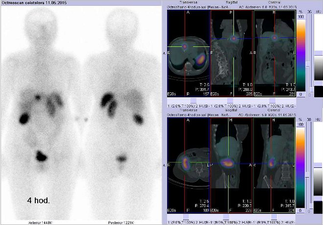 Obr. . 1: Celotlov scintigrafie v pedn a zadn projekci a fze SPECT/CT 4 hod. po aplikaci OctreoScanu. Nahoe vpravo zameno na loisko ve ventrln sti jater na rozhran pravho a levho laloku. Dole vpravo zameno na pravou ledvinu.