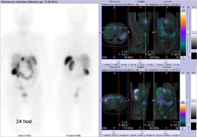 Obr. . 2: Celotlov scintigrafie vpedn a zadn projekci a fze SPECT/CT 24 hod. po aplikaci OctreoScanu. Nahoe vpravo zameno na loisko ve ventrln sti jater na rozhran pravho a levho laloku. Dole vpravo zameno na levou st pnho tranku.