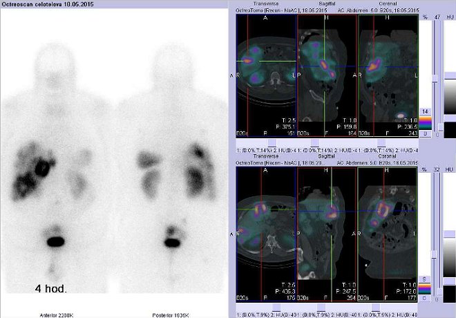 Obr. . 4: Celotlov scintigrafie a fze obraz SPECT a CT  vyeten bicha. Vyeten 4 hod. po aplikaci radiofarmaka. Vdy nad sebou: vlevo transverzln ezy, uprosted sagitln ezy, vpravo koronrn. Vpravo nahoe a dole zameno na loiska vjtrech.