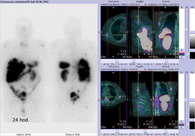 Obr. . 5: Celotlov scintigrafie a fze obraz SPECT a CT  vyeten hrudnku. Vyeten 24 hod. po aplikaci radiofarmaka. Vdy nad sebou: vlevo transverzln ezy, uprosted sagitln ezy, vpravo koronrn. Vpravo nahoe a dole zameno na loiska v obou lopatkch.