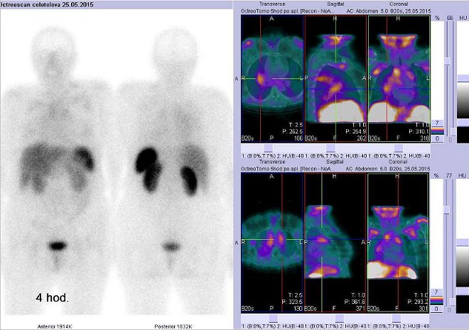Obr..2: Celotlov scintigrafie a fze obraz SPECT a CT  vyeten hrudnku. Vyeten 4 hod. po aplikaci radiofarmaka. Vdy nad sebou: vlevo transverzln ezy, uprosted sagitln, vpravo koronrn. Vpravo nahoe a dole zameno na loiska vplicch a mediastinu.