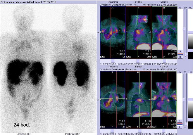 Obr. . 4: Celotlov scintigrafie a fze obraz SPECT a CT  vyeten hrudnku. Vyeten 24 hod. po aplikaci radiofarmaka. Vdy nad sebou: vlevo transverzln ezy, uprosted sagitln, vpravo koronrn. Vpravo nahoe a dole zameno na loiska v mediastinu.