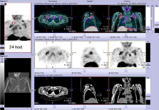 Obr. . 5: Fze obraz SPECT a CT  vyeten hrudnku a krku. Vyeten 24 hod. po aplikaci radiofarmaka. Nahoe fze obraz, uprosted SPECT, dole CT. Vdy nad sebou: vlevo transverzln ezy, uprosted sagitln, vpravo koronrn. Zameno na uzliny vprav axile.