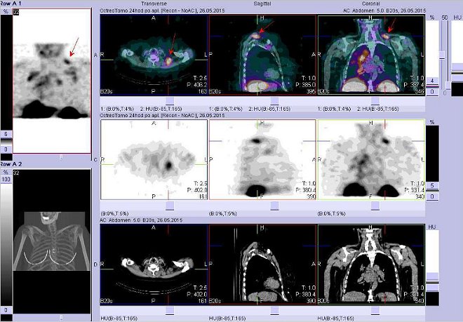 Obr. . 6: Fze obraz SPECT a CT  vyeten hrudnku a krku. Vyeten 24 hod. po aplikaci radiofarmaka. Nahoe fze obraz, uprosted SPECT, dole CT. Vdy nad sebou: vlevo transverzln ezy, uprosted sagitln, vpravo koronrn. Zameno na uzliny na krku vlevo.